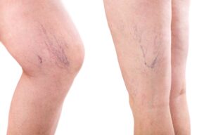 Embarking on Your Sclerotherapy Journey with Serene Skin & Beauty