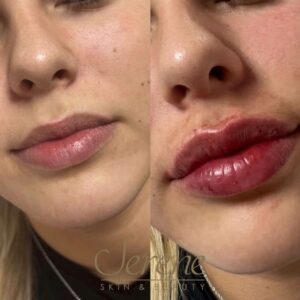 Lip Filler