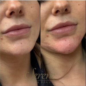 Chin Augmentation
