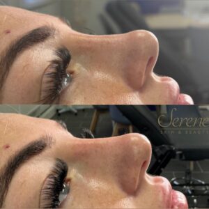 Non-surgical Rhinoplasty
