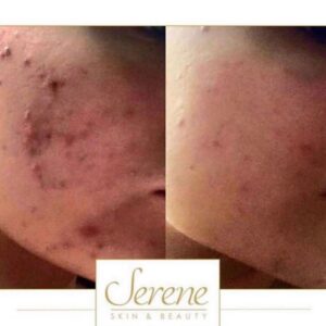 Clearskin Pro: Advanced Acne & Skin Rejuvenation Laser Treatment